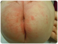 Dış Popoda Kaşıntı Sebepleri