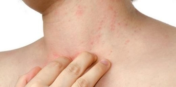 Alerjik Kaşıntı Belirtileri ve Tedavisi